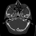 Cerebral hemorrhagic contusions (Radiopaedia 23145-23188 Axial bone window 10).jpg