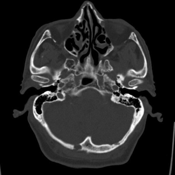 File:Cerebral hemorrhagic contusions (Radiopaedia 23145-23188 Axial bone window 10).jpg