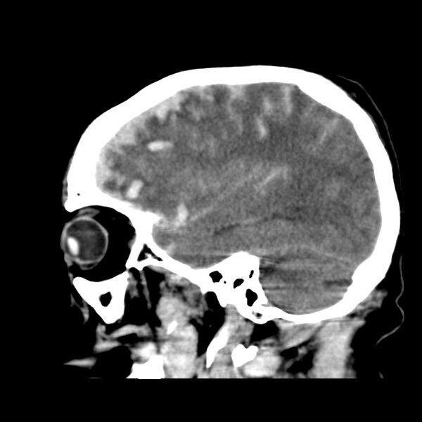File:Cerebral hemorrhagic contusions (Radiopaedia 23145-23188 C 32).jpg