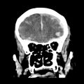 Cerebral hemorrhagic contusions (Radiopaedia 23145-23188 Coronal non-contrast 12).jpg