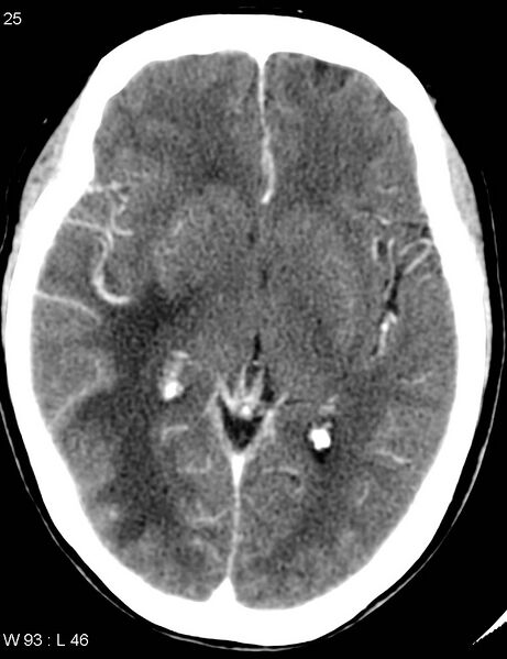 File:Cerebral metastasis - lung cancer (Radiopaedia 5315-7072 Axial C+ delayed 1).jpg