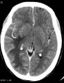 Cerebral metastasis - lung cancer (Radiopaedia 5315-7072 Axial C+ delayed 1).jpg