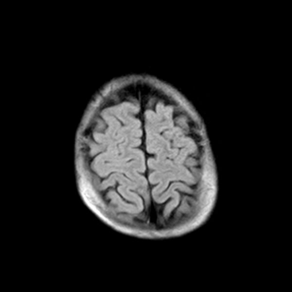 File:Cerebral tuberculoma (Radiopaedia 41152-43932 Axial FLAIR 20).jpg