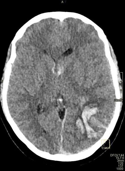 File:Cerebral venous sinus thrombosis (Radiopaedia 91329-108965 Axial non-contrast 26).jpg