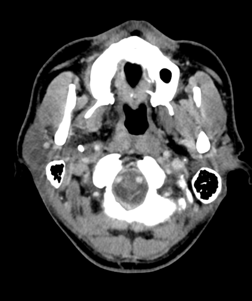 File:Cervical abscess (Radiopaedia 43725-47184 A 12).png