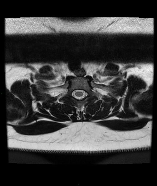 File:Cervical disc prolapse (Radiopaedia 80258-93598 Axial T2 81).jpg