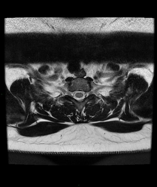 File:Cervical disc prolapse (Radiopaedia 80258-93598 Axial T2 85).jpg