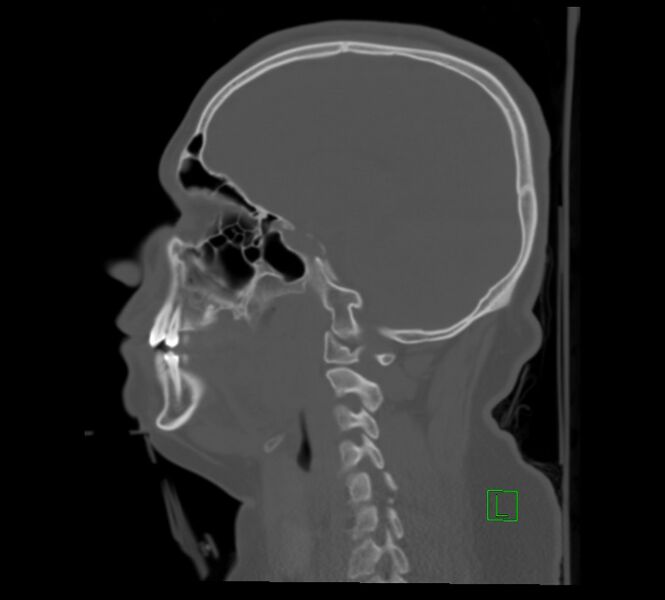 File:Cervical spine fracture - hyperflexion injury (Radiopaedia 66184-75364 A 18).jpg