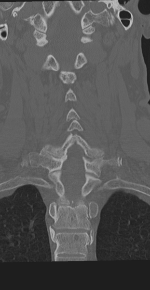 File:Cervical spine fracture in the setting of ankylosis (Radiopaedia 37038-38715 Coronal bone window 43).png