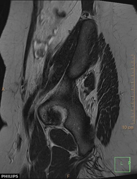 File:Cesarian scar endometriosis (Radiopaedia 68495-78066 Sagittal T2 1).jpg