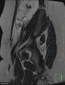Cesarian scar endometriosis (Radiopaedia 68495-78066 Sagittal T2 1).jpg