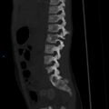 Chance fracture with duodenal and pancreatic lacerations (Radiopaedia 43477-50042 Sagittal bone window 6).jpg