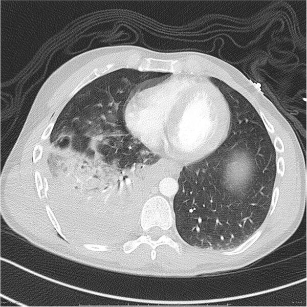 File:Chest and abdomen multi-trauma (Radiopaedia 26294-26425 lung window 74).jpg