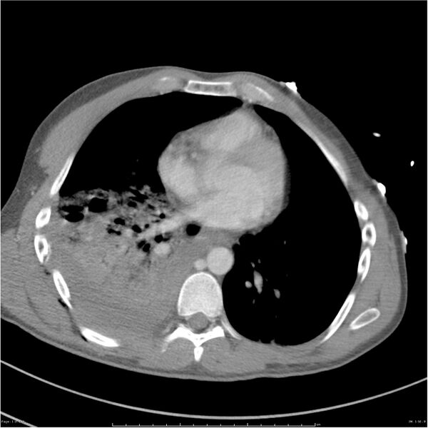 File:Chest and abdomen multi-trauma (Radiopaedia 26294-26426 bone window 1).jpg
