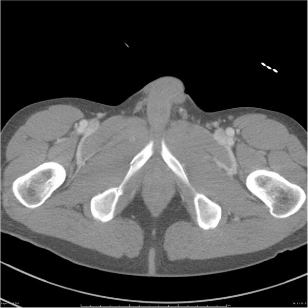 File:Chest and abdomen multi-trauma (Radiopaedia 26294-26426 bone window 93).jpg
