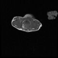 Chiari II malformation with spinal meningomyelocele (Radiopaedia 23550-23652 Axial T1 19).jpg