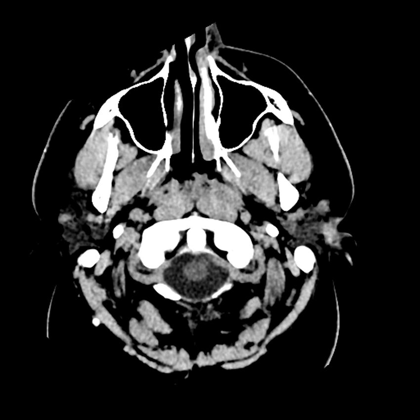 Chiasmatic-hypothalamic juvenile pilocytic astrocytoma (Radiopaedia 78533-91237 Axial non-contrast 6).jpg