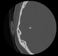 Cholesteatoma (Radiopaedia 20296-20217 bone window 40).jpg