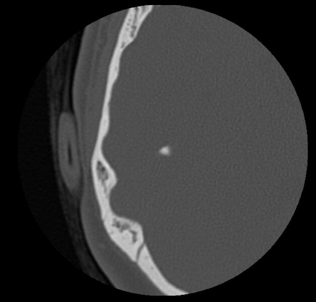 File:Cholesteatoma (Radiopaedia 20296-20217 bone window 40).jpg
