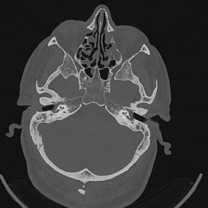 Cholesteatoma (Radiopaedia 68176-77673 Axial bone window 37).jpg