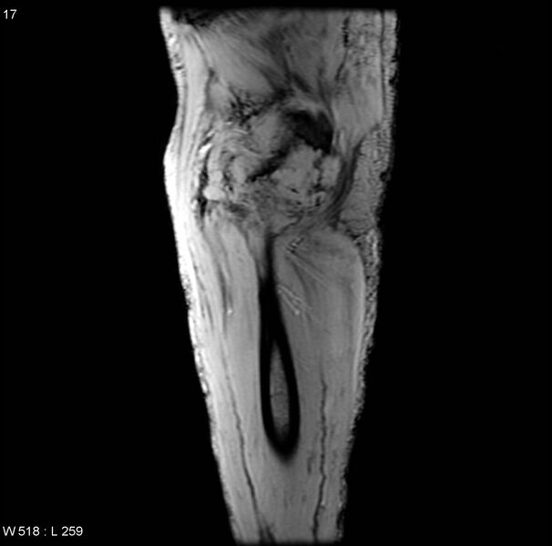 File:Chondrosarcoma with pathological fracture - femur (Radiopaedia 6174-7629 B 2).jpg