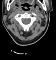 Chordoma (C4 vertebra) (Radiopaedia 47561-52188 Axial non-contrast 14).png