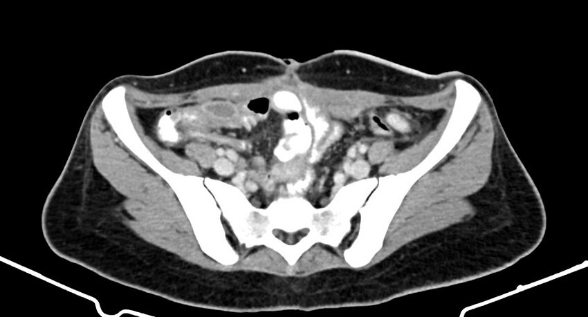 Choriocarcinoma liver metastases (Radiopaedia 74768-85766 A 159).jpg