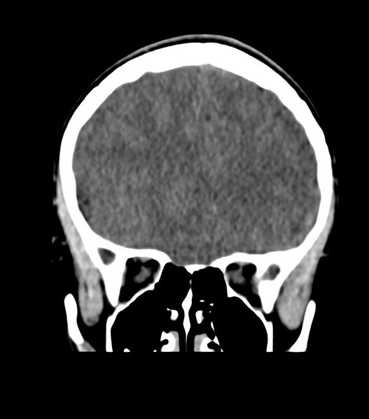 File:Choroid plexus carcinoma (Radiopaedia 91013-108552 Coronal non-contrast 25).jpg