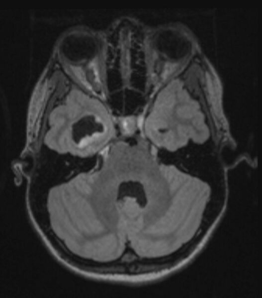 File:Choroid plexus carcinoma (Radiopaedia 91013-108553 Axial FLAIR C+ 100).jpg