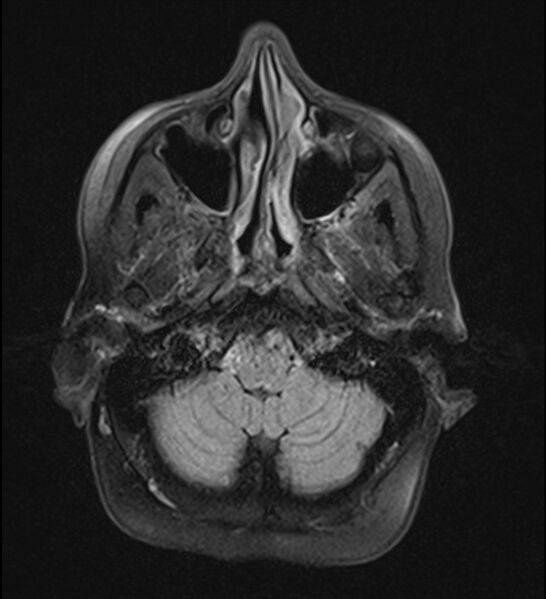 File:Choroid plexus xanthogranuloma (Radiopaedia 91271-108875 Axial T2 TIRM 5).jpg