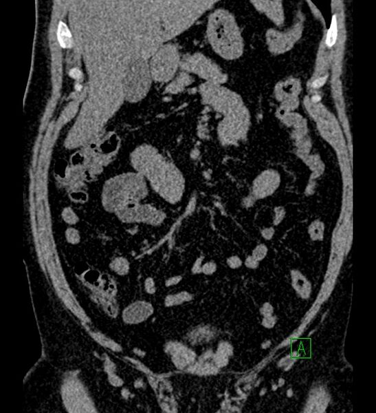 File:Chromophobe renal cell carcinoma (Radiopaedia 84286-99573 Coronal non-contrast 57).jpg