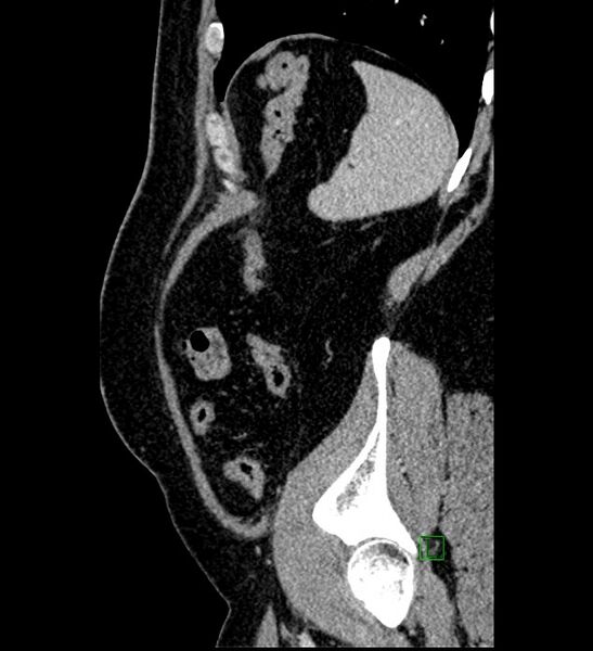 File:Chromophobe renal cell carcinoma (Radiopaedia 84286-99573 I 27).jpg