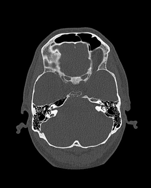 File:Chronic maxillary sinusitis caused by a foreign body (Radiopaedia 58521-65676 Axial bone window 255).jpg
