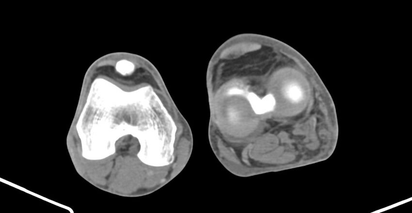 Chronic osteomyelitis (with sequestrum) (Radiopaedia 74813-85822 D 189).jpg