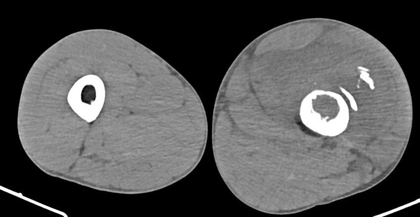 Chronic osteomyelitis (with sequestrum) (Radiopaedia 74813-85822 D 92).jpg
