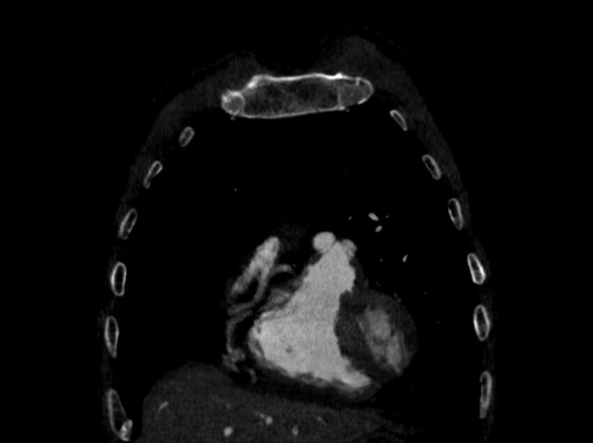 Chronic pulmonary embolism (Radiopaedia 91241-108843 A 13).jpg