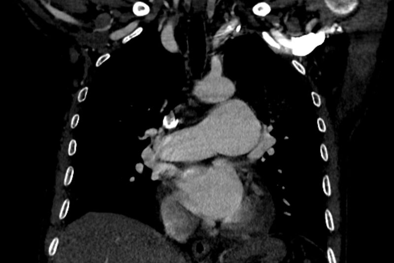 File:Chronic pulmonary embolism with bubbly consolidation (Radiopaedia 91248-108850 B 70).jpg