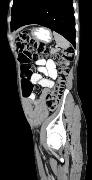 File:Chronic small bowel volvulus (Radiopaedia 75224-86322 C 37).jpg