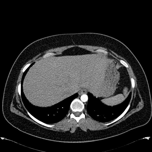 File:Chronic thromboembolic pulmonary hypertension (CTEPH) (Radiopaedia 74597-85531 Axial C+ CTPA 44).jpg
