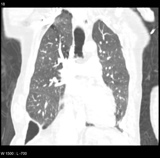 File:Clagett thoracotomy (Radiopaedia 8568-9403 Coronal lung window 18).jpg