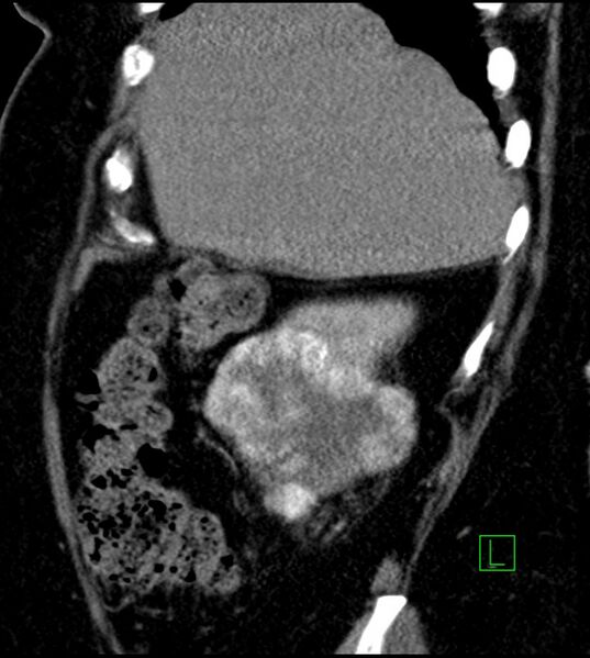 File:Clear cell renal cell carcinoma (Radiopaedia 85004-100537 D 51).jpg
