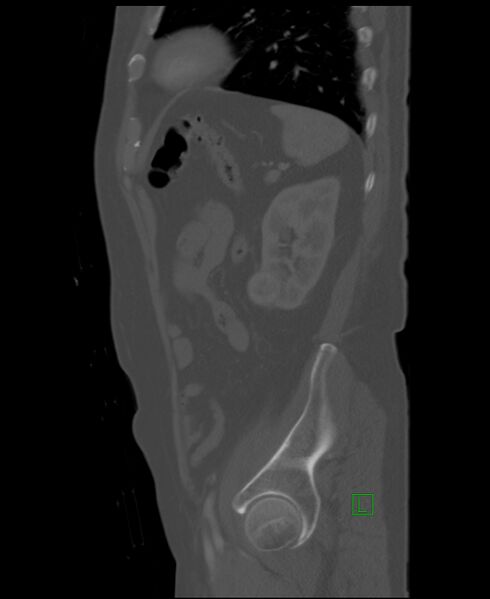 File:Clear cell renal cell carcinoma (Radiopaedia 85006-100539 Sagittal bone window 14).jpg