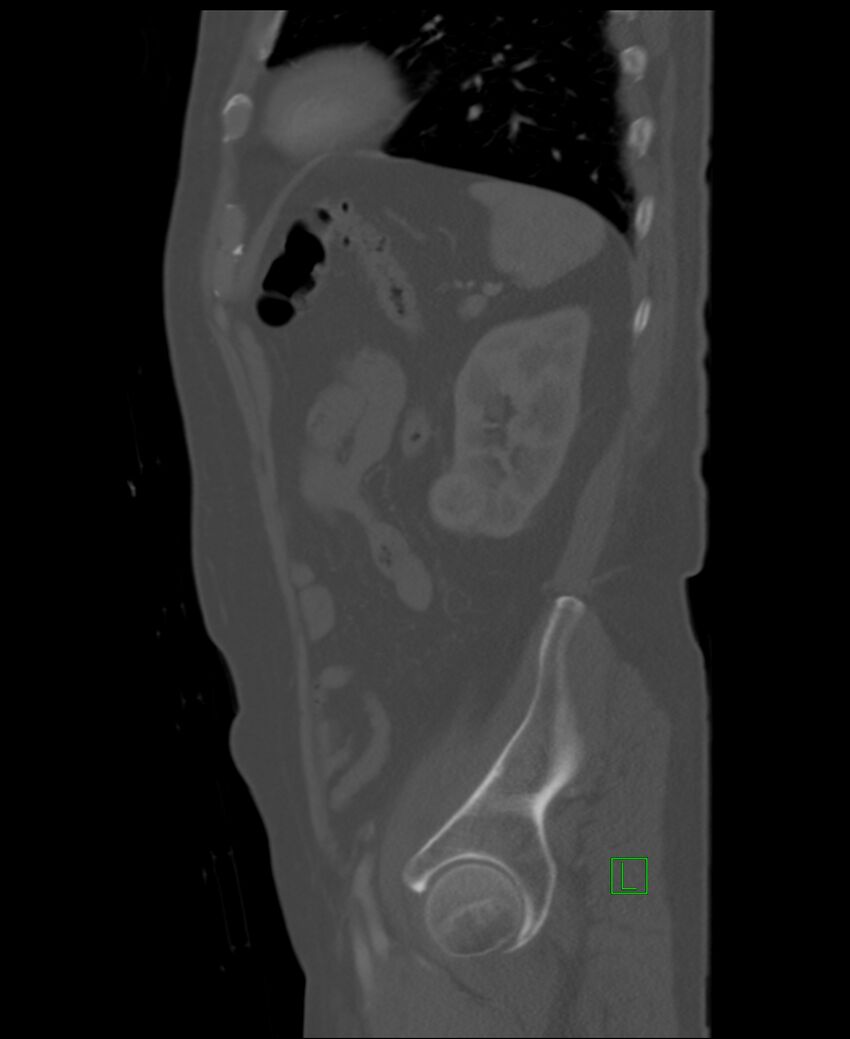 Clear cell renal cell carcinoma (Radiopaedia 85006-100539 Sagittal bone window 14).jpg