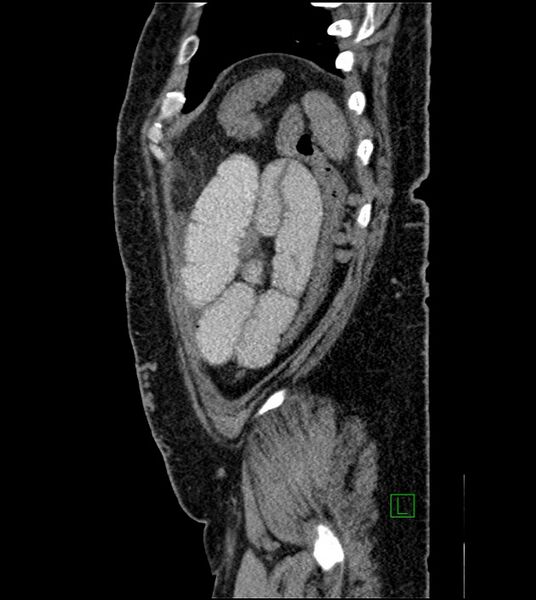 File:Closed-loop small bowel obstruction-internal hernia (Radiopaedia 78439-91096 C 28).jpg