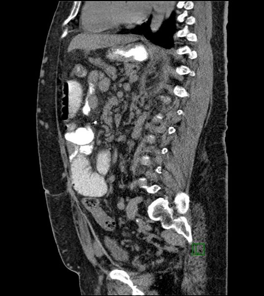 File:Closed-loop small bowel obstruction-internal hernia (Radiopaedia 78439-91096 C 67).jpg