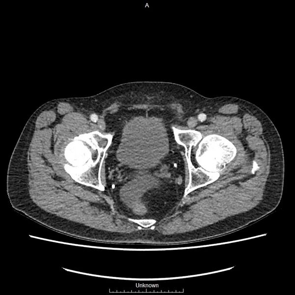 File:Closed loop bowel obstruction and ischemia (Radiopaedia 86959-103180 A 83).jpg
