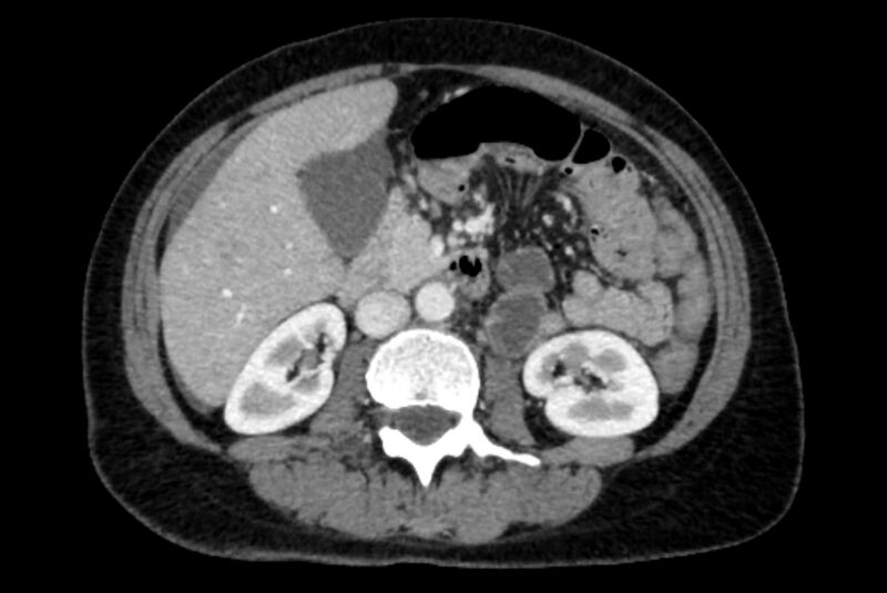 File:Closed loop small bowel obstruction (Radiopaedia 71211-81508 A 45).jpg