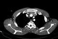 Coarctation of aorta with aortic valve stenosis (Radiopaedia 70463-80574 A 11).jpg