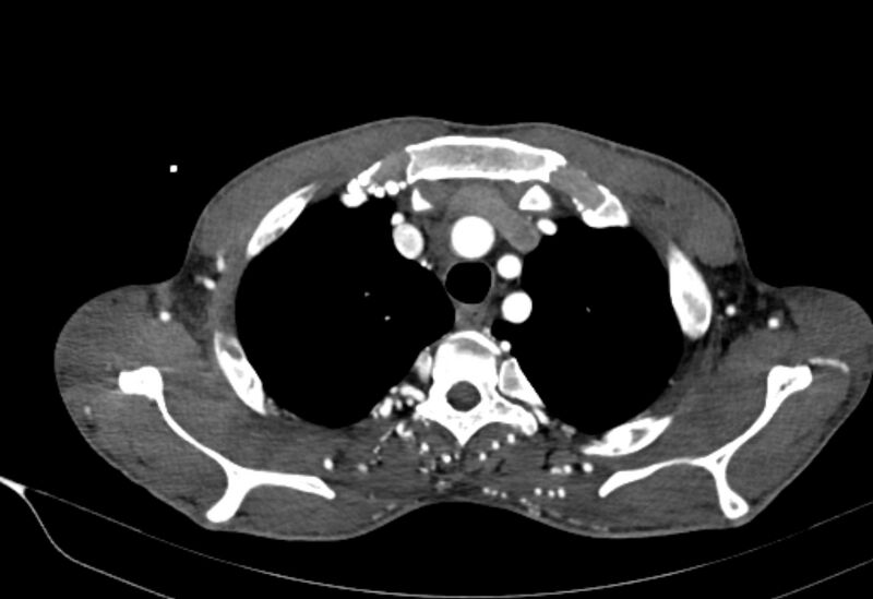 File:Coarctation of aorta with aortic valve stenosis (Radiopaedia 70463-80574 A 11).jpg