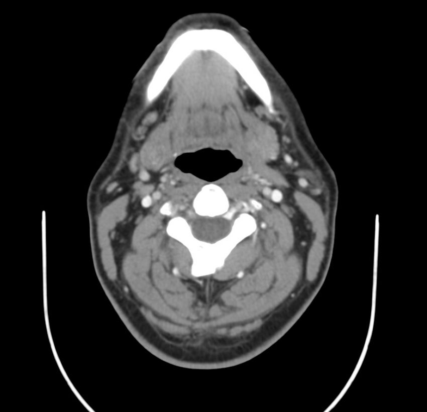 Colloid cyst of thyroid (Radiopaedia 22897-22923 Axial C+ delayed 32).jpg